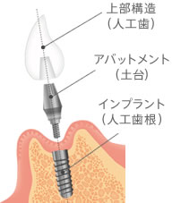 上部構造（人工歯）アパットメント（土台）インプラント（人工歯根）